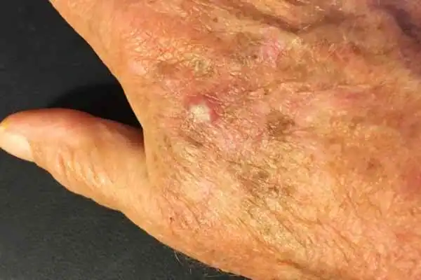 Cryopen For Actinic Keratoses 1 Image of Actinic keratoses Folkestone on a person hand
